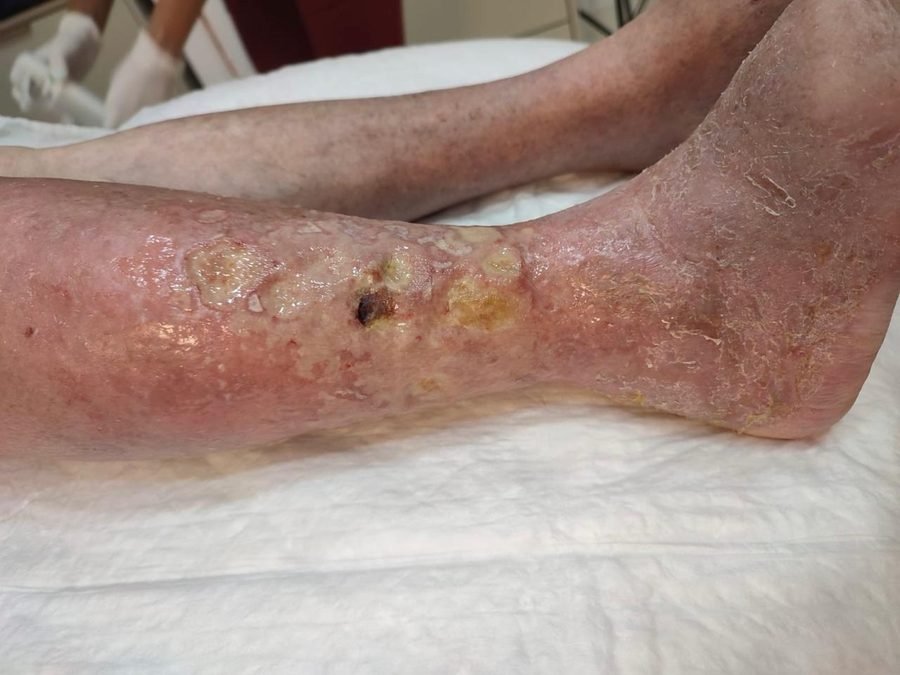 Imagem clínica desfocada. Erisipela bolhosa no início do acompanhamento.
