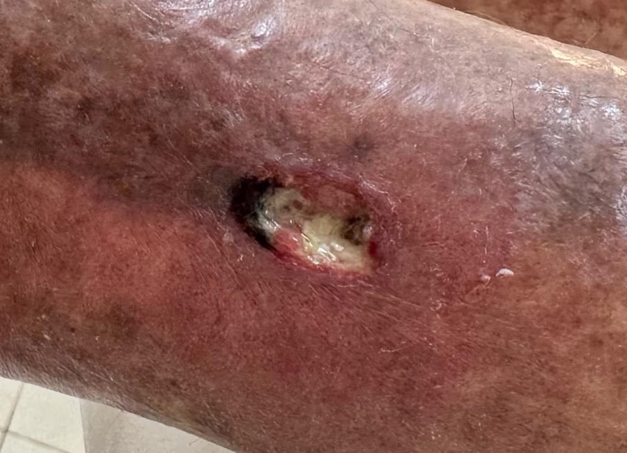 Imagem clínica desfocada. Úlcera arterial no início do acompanhamento.