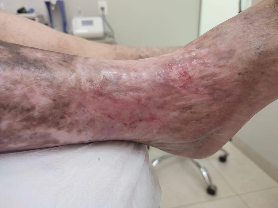 Imagem clínica desfocada. Úlcera venosa após 4 meses de acompanhamento.