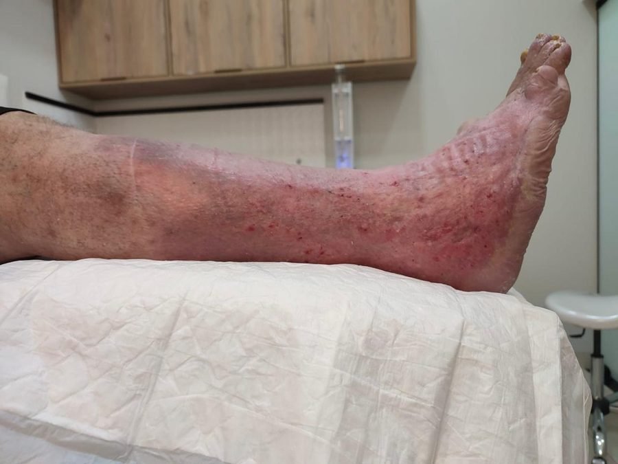 Imagem clínica desfocada. Úlcera venosa após 6 meses de acompanhamento.
