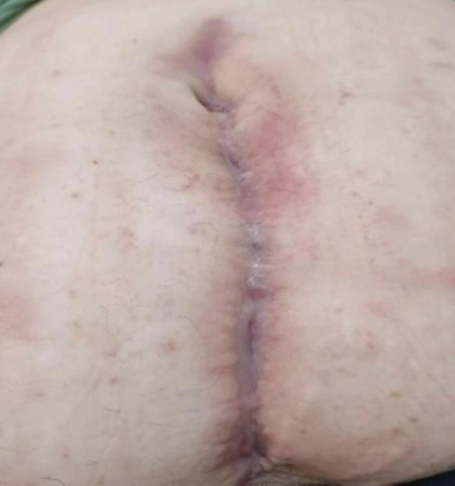 Imagem clínica desfocada. Deiscência pós-cirúrgica após 2 meses de acompanhamento.