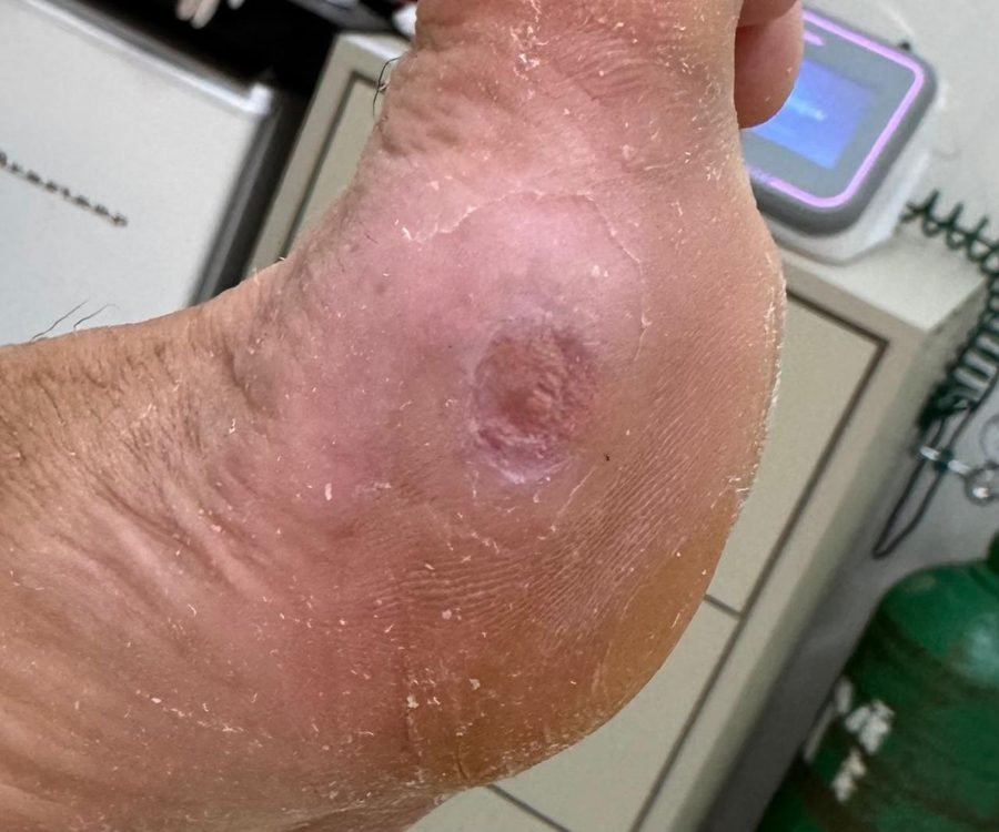 Imagem clínica desfocada. Pé diabético após 2 meses de acompanhamento.