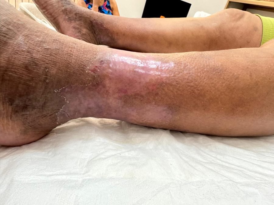 Imagem clínica desfocada. Psoríase após 1 sessão de acompanhamento.