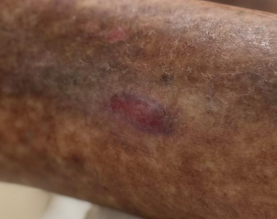 Imagem clínica desfocada. Úlcera arterial após 2 meses de acompanhamento.