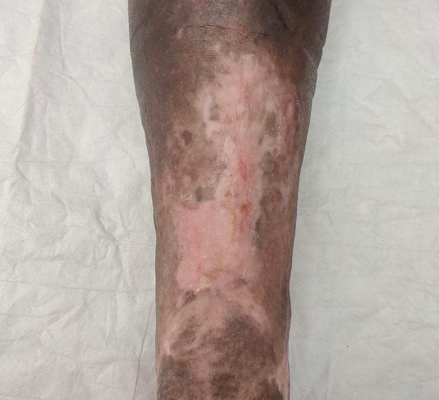 Imagem clínica desfocada. Úlcera venosa após 2 meses de acompanhamento.