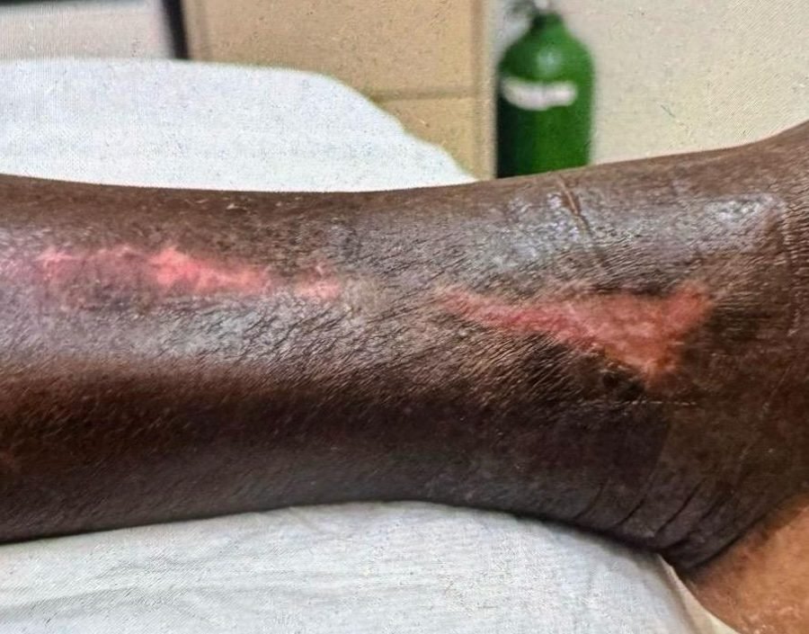 Imagem clínica desfocada. Erisipela após 3 meses de acompanhamento.