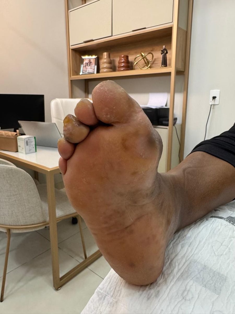 Imagem clínica desfocada. Pé diabético após 1 mês de acompanhamento.